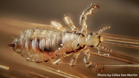 Microscopic view of a louse crawling on hair at the lice treatment clinic in Dublin OH