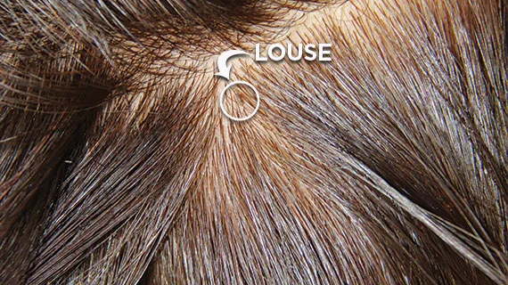Picture of head louse in the hair by Lice Clinics of America - Columbus, OH